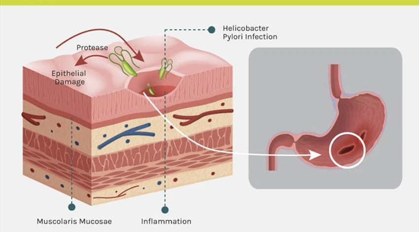 Helicobacter pylori Helicobacter pylori